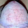 男性念珠菌龟头炎做什么检查好呢