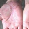 手足癣主要症状是什么
