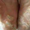 治疗手足癣费用是多少