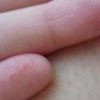 手足癣怎么治疗手足癣最好的医院