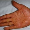 青岛皮肤病研究院治疗手足癣哪里好