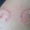 体癣如何防止护理