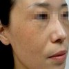 黄褐斑症状和按照生长部位分型
