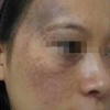 女性黄褐斑的特点