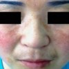 雀斑和黄褐斑的症状有什么不同