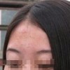 女性脸上长了黄褐斑怎么办