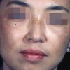 黄褐斑治疗应遵循什么原则