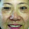 黄褐斑怎么样才能除掉