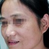 怎么除掉脸上黄褐斑