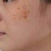 介绍黄褐斑的治疗的手法