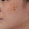 那些食物可以辅助黄褐斑的治疗