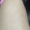 毛囊炎患者在平日的饮食中小心些什么