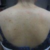 毛囊炎患者在饮食方面要小心什么
