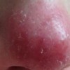 酒糟鼻日常预防措施