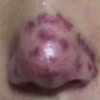 酒糟鼻有哪些原因