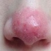 酒糟鼻患者在不同发病时期表现的症状