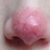 酒糟鼻能治疗吗