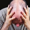 检查脱发需要哪几种检查