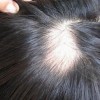女性朋友如何有效的预防脱发
