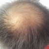 男性型脱发的症状表现