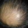 急慢性脂溢性脱发的不同表现