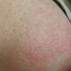 接触性皮炎不能吃什么
