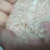 硬皮病患者在皮肤方面的表现