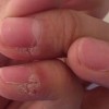 寻常疣怎样的预防