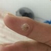 怎样预防寻常疣