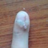 治疗寻常疣最好的措施是什么