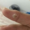 嘴角寻常疣如何治疗