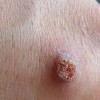治疗寻常疣的偏方