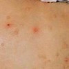 宝宝传染性软疣症状