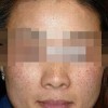 良好的习惯可以预防雀斑