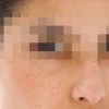 生活中如何防止雀斑呢