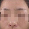 雀斑可以预防吗