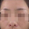 如何更有效的预防雀斑