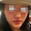 可以有效预防雀斑出现的措施是什么