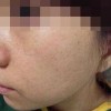 脸部雀斑的有效预防