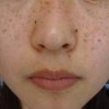 女性朋友该怎样的预防雀斑