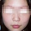如何防止儿童脸上长雀斑
