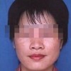 青岛治疗雀斑去哪家医院好