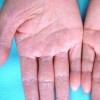 手足癣有何特点及日常护理注意什么