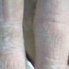 手足癣的症状表现以及治疗的手法