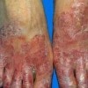 手足癣的症状有哪些