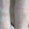 手足癣患者常见的症状表现有哪些