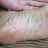 手足癣的主要症状是什么