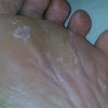 水泡型手足癣如何治疗