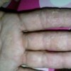 手足癣怎么治