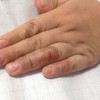 手足癣能治疗好吗_手足癣